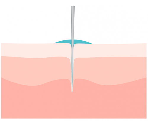 Microneedling