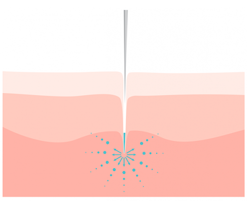 Microneedling