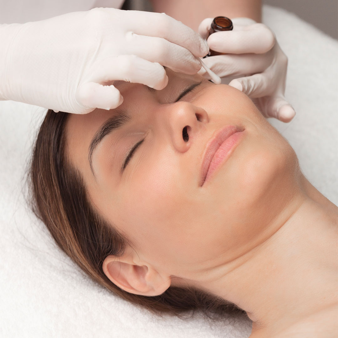 skin-peels-treatment-sudbury