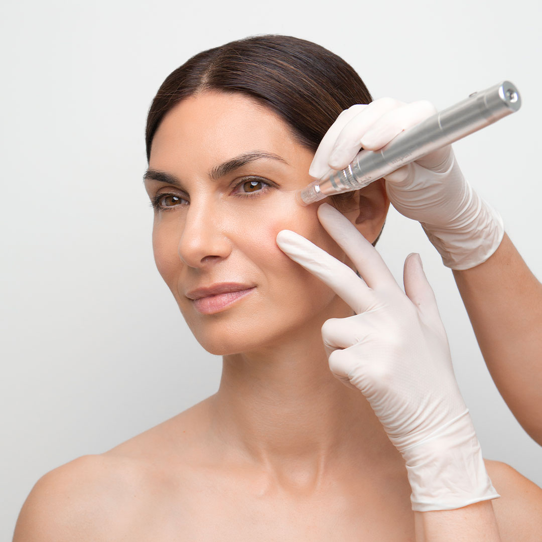 microneedling-treatment-clare